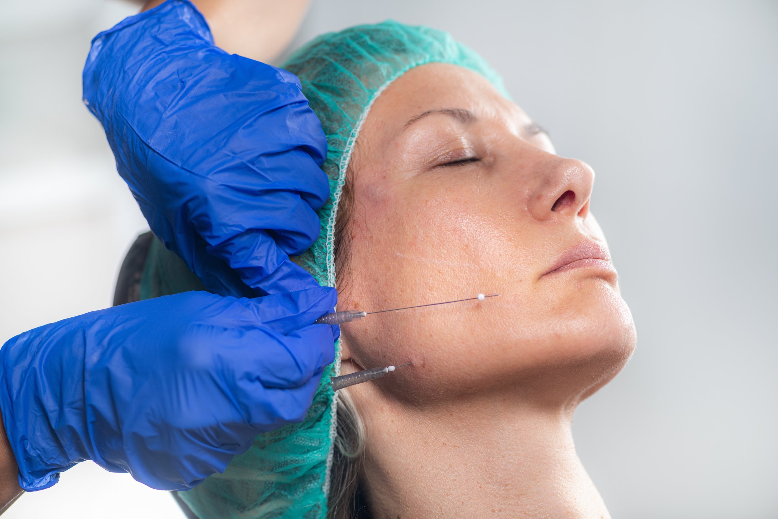 Mesotherapy thread face lift procedure